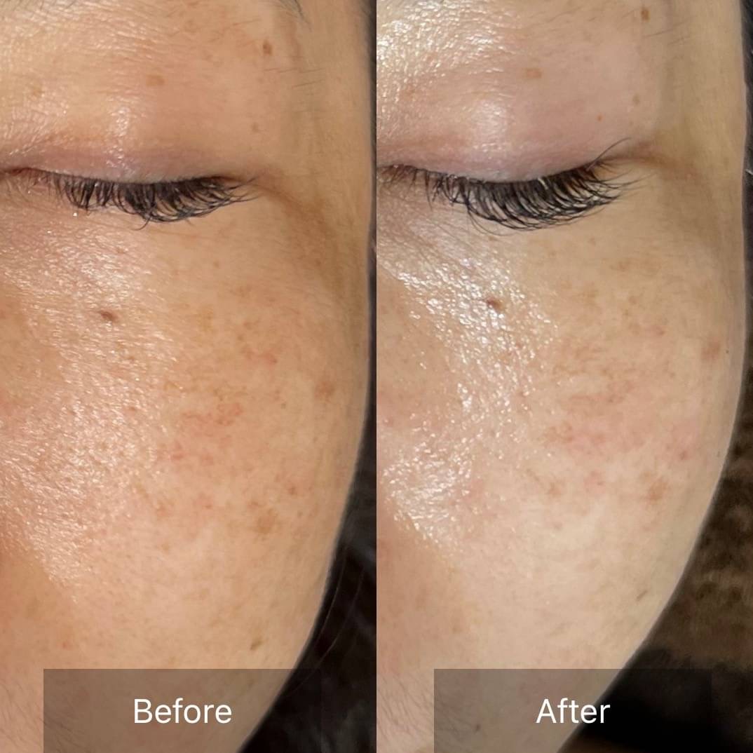 お肌の悩みがある方必見！ビフォーアフター