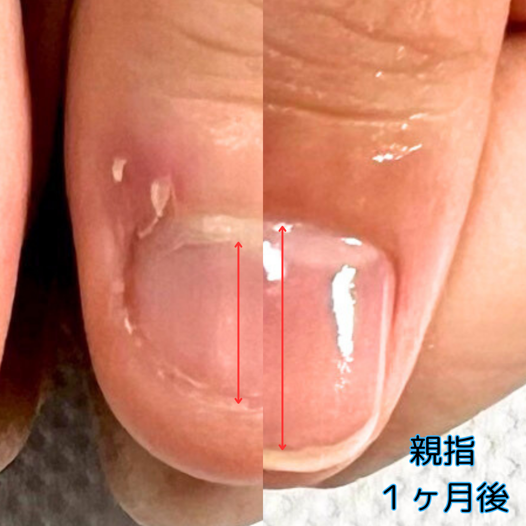 自爪育成１ヶ月でここまで変わります