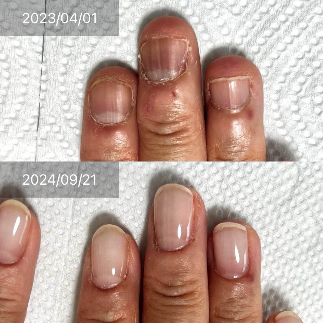 1年4.5ヶ月でネイルデザインを楽しめる爪に！