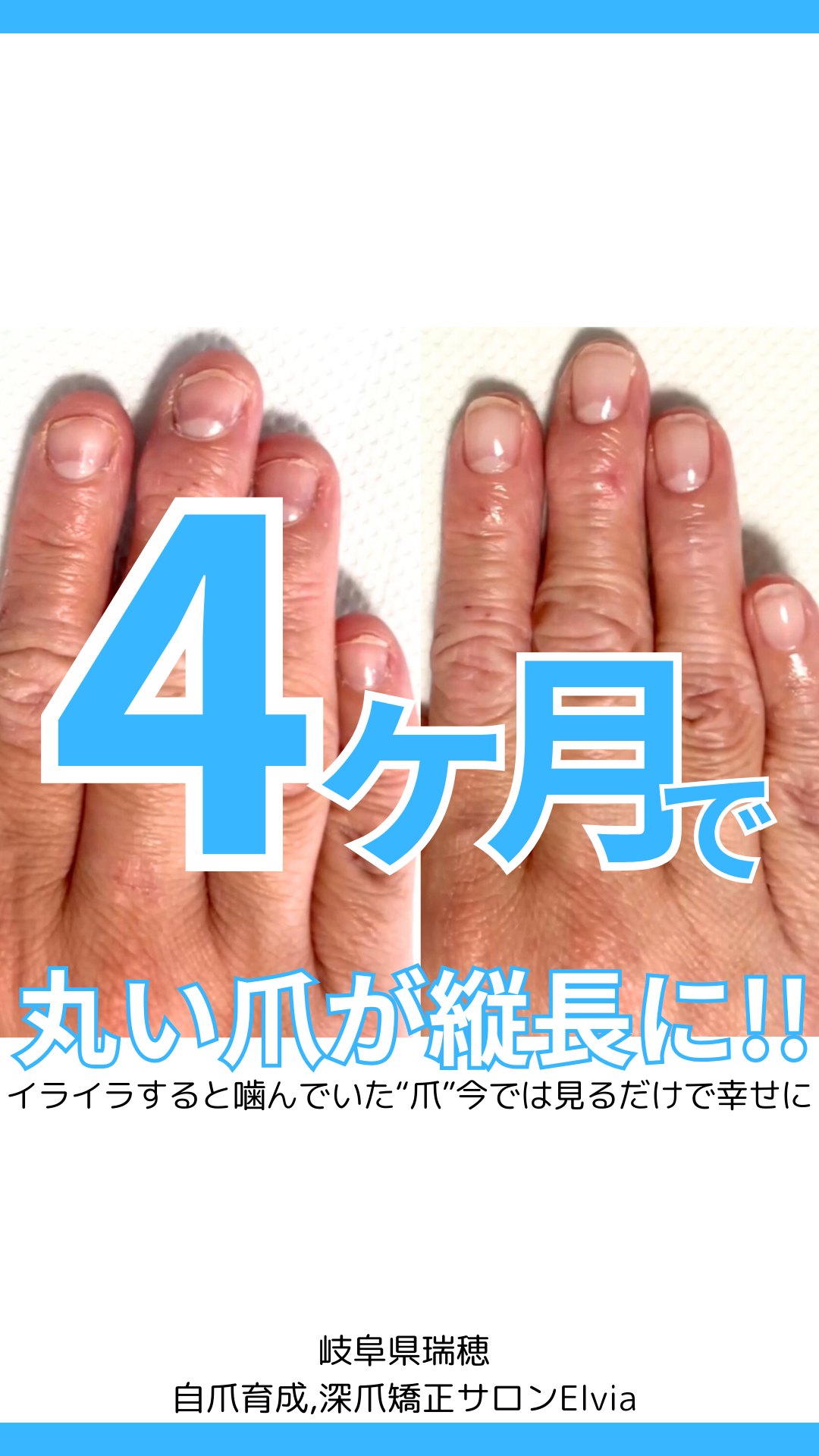 イライラするとつい噛んでしまっていたそうです